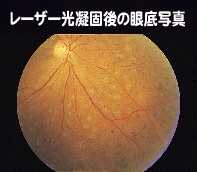 レーザー光凝固術後