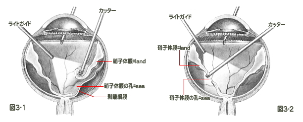 硝子体手術
