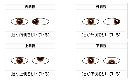 斜視