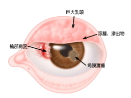 春季カタル