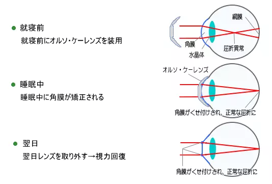 矯正の仕組み